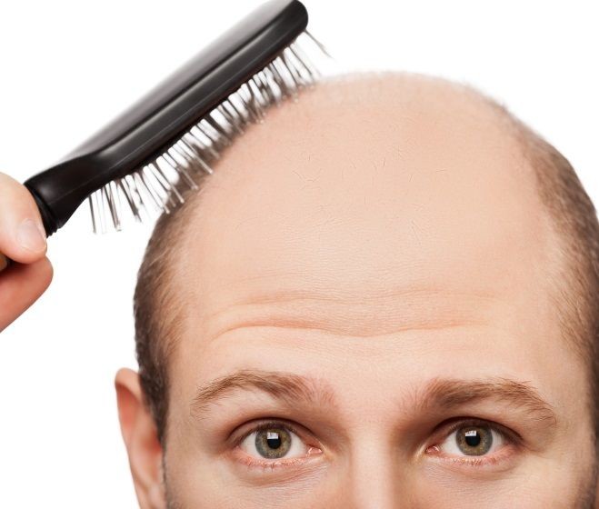 Typy plešatění: Androgenní alopecie aneb striktně mužská záležitost. Nebo ne?