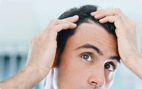 Typy plešatění: Za jizvící alopecii může zánět. Zbavit se ho ovšem není lehké